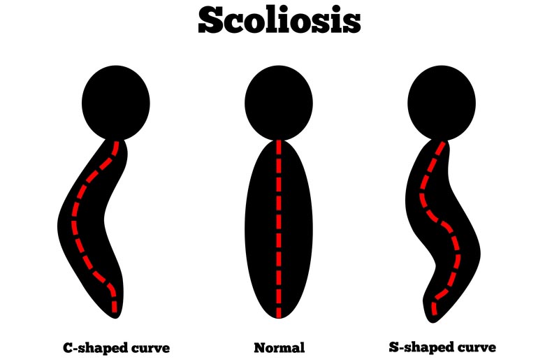 Hickory, NC scoliosis treatment